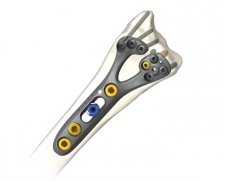 Skeletal Dynamics GEMINUS Volar Distal Radius Plating System | Used in Fracture plating, Plating of distal radius  | Which Medical Device